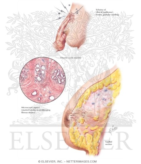 Breast: Pain (Mastodynia, Mastalgia)