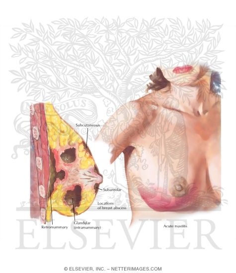 Watermarked preview of labeled image: Mastitis (Lactational)