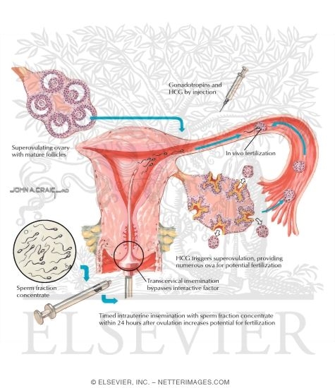 Watermarked preview of labeled image: Assisted Reproduction