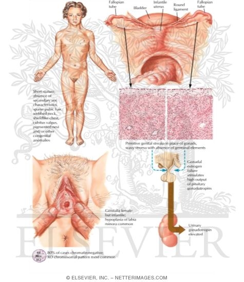 Syndrome of Gonadal Dysgenesis (Turner's Syndrome)