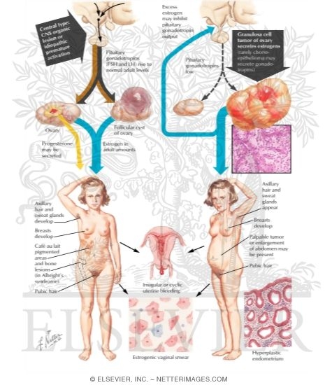 Precocious Puberty (Continued)
