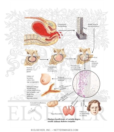 Postpartum Pituitary Necrosis