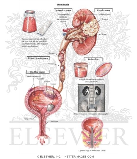 Hematuria