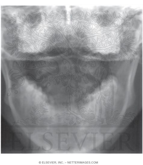 Radiograph of Atlantoaxial Joint