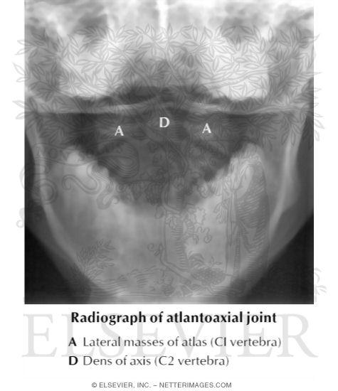 Radiograph of Atlantoaxial Joint
