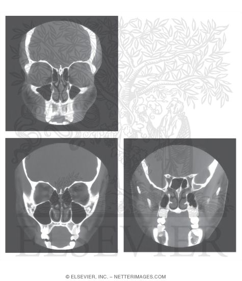 Head Scans: Coronal CT Images