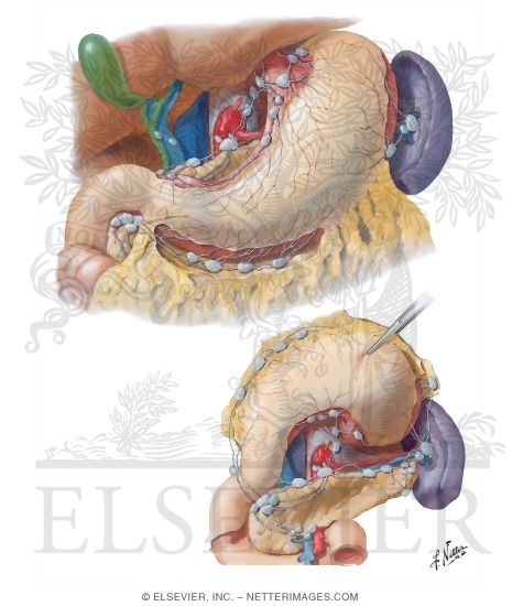 Watermarked preview of unlabeled image: Lymph Vessels and Nodes of Stomach