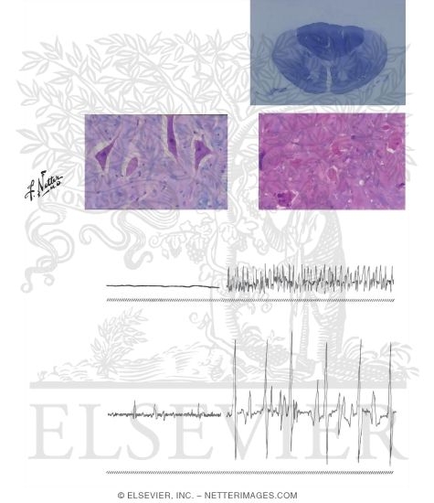 Watermarked preview of unlabeled image: Primary Motor Neuron Disease