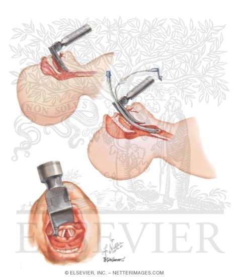 Watermarked preview of unlabeled image: Endotracheal Intubation