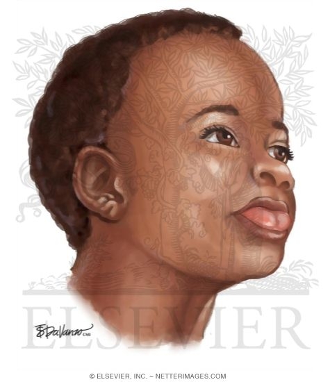 Beckwith-Wiedemann Syndrome: Macroglossia