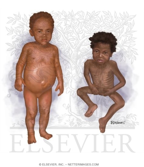 Malnutrition