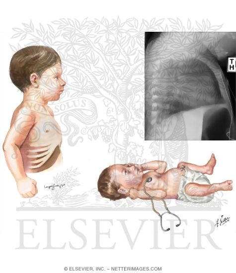 Watermarked preview of unlabeled image: Clinical Evaluation of Wheezing and Bronchiolitis