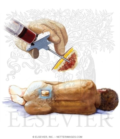 Watermarked preview of unlabeled image: Bone Marrow Evaluation
