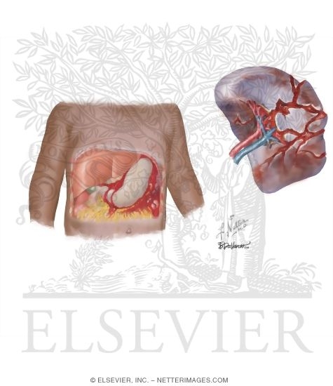 Splenic Laceration