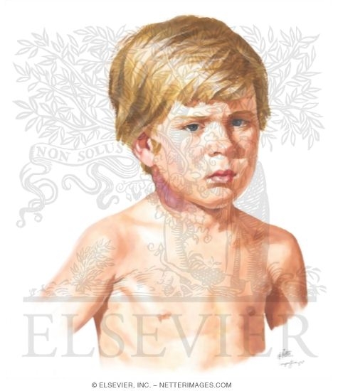 Child With Cervical Lymphadenitis Secondary to Nontuberculosis