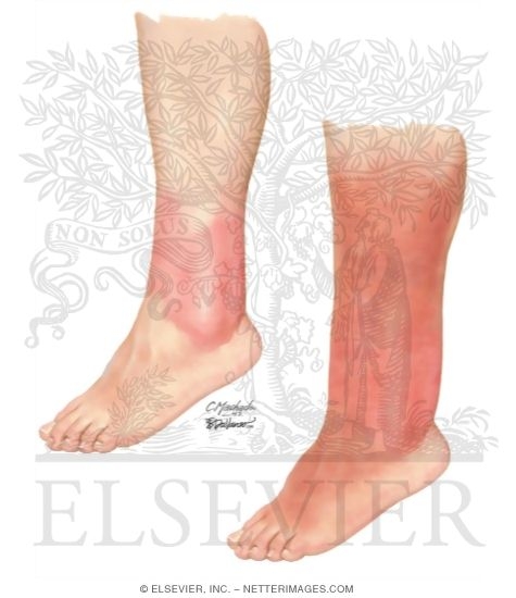 Appearance of Erysipleas and Cellulitis