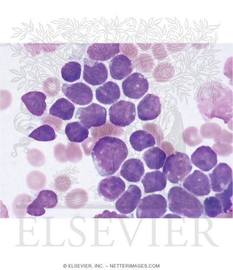 Clinical Presentation of Leukemia: Acute Lymphoblastic Leukemia