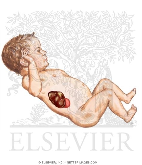 Watermarked preview of unlabeled image: Overview of Neuroblastoma