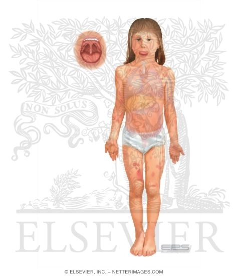 Anaphylaxis