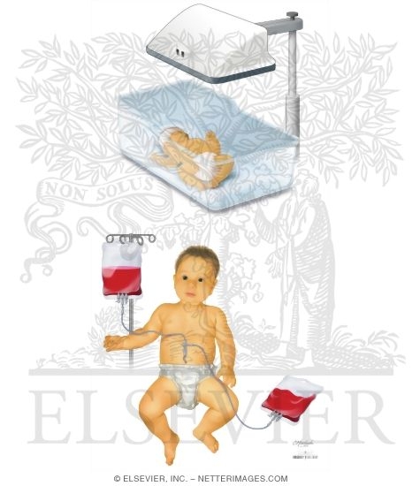 Watermarked preview of unlabeled image: Phototherapy and Exchange Transfusion In Hyperbilirubinemia