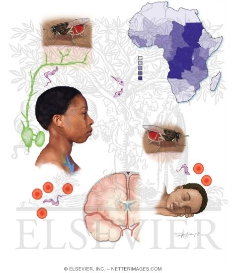 Watermarked preview of unlabeled image: Trypanosomiasis: African Sleeping Sickness