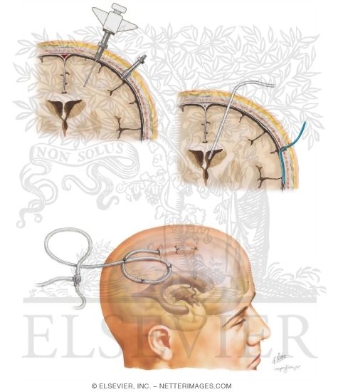 Watermarked preview of unlabeled image: Intensive Medical Management of Severe Head Injury
