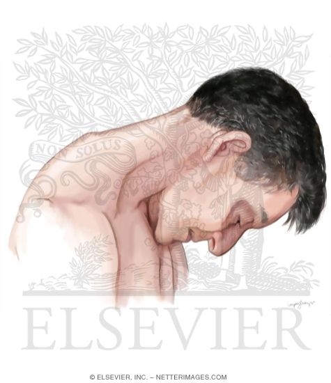 Head Drop In Amyotrophic Lateral Sclerosis