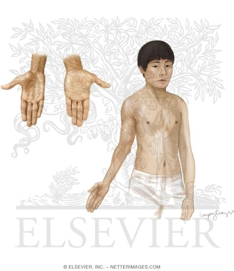 Watermarked preview of unlabeled image: Hirayama Disease