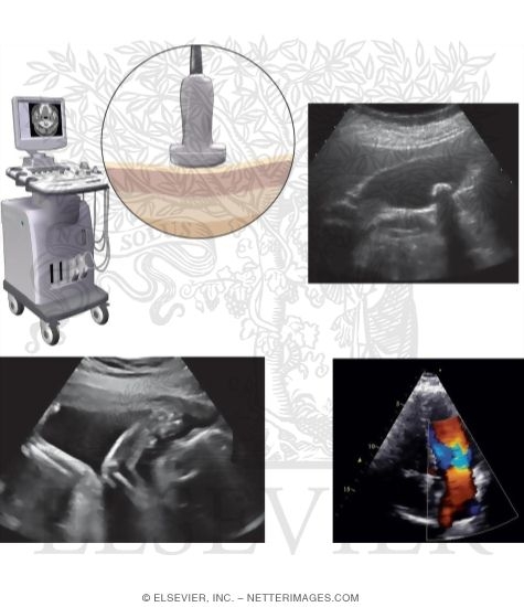 Ultrasound