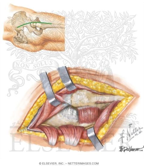 Watermarked preview of unlabeled image: Surgical Approaches: Kocher-Langenbeck Approach