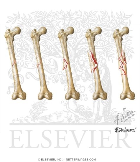 Watermarked preview of unlabeled image: Trauma: Femoral Shaft Fracture