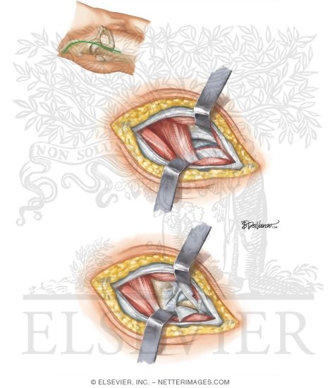 Watermarked preview of unlabeled image: Surgical Approaches: Anterior (Smith-Peterson) Approach to Hip