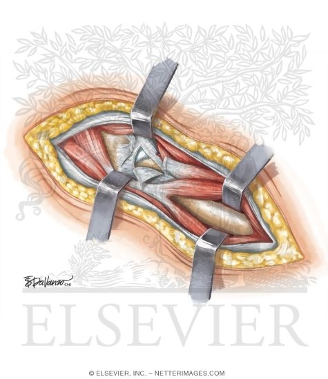 Surgical Approaches: Anterior (Smith-Peterson) Approach to Hip