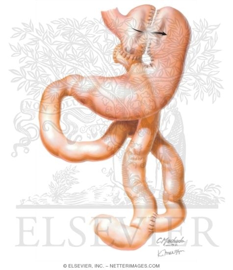 Watermarked preview of unlabeled image: Complications of Bariatric Surgery