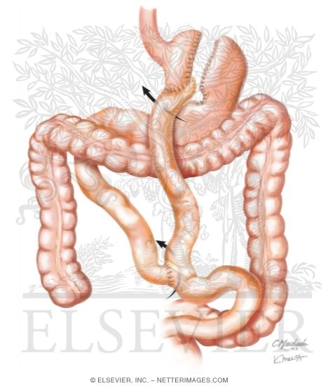 Watermarked preview of unlabeled image: Complications of Bariatric Surgery