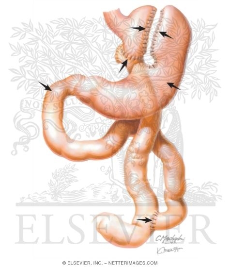 Watermarked preview of unlabeled image: Complications of Bariatric Surgery