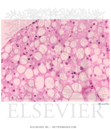 Watermarked preview of unlabeled image: Nonalcoholic Steatohepatitis