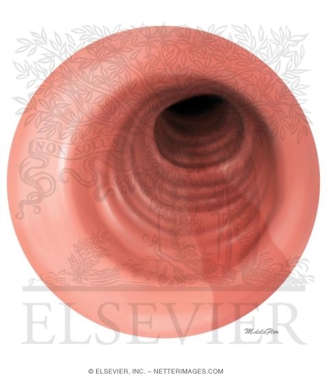 Watermarked preview of unlabeled image: Eosinophilic Esophagitis