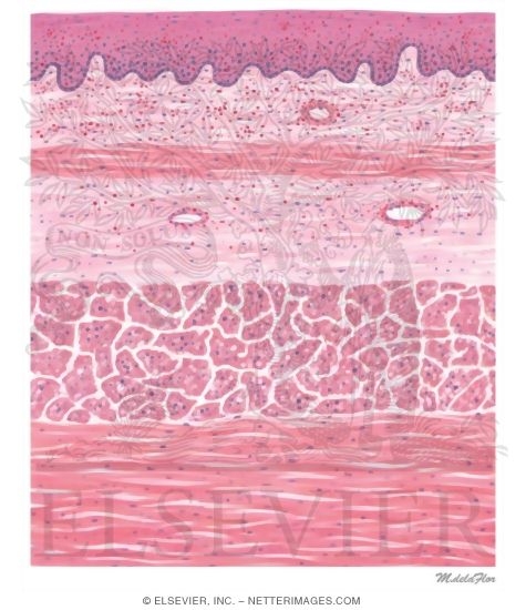 Watermarked preview of unlabeled image: Eosinophilic Esophagitis