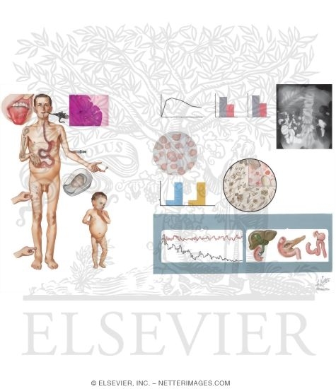 Watermarked preview of unlabeled image: Signs and Symptoms of Malabsorption