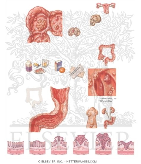 Neoplasms of the Large Bowel: Colon Polyps