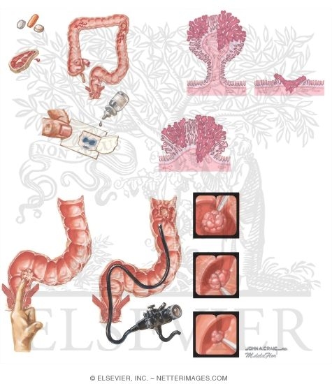 Watermarked preview of unlabeled image: Neoplasms of the Large Bowel: Screening and Treatment of Colon Polyps