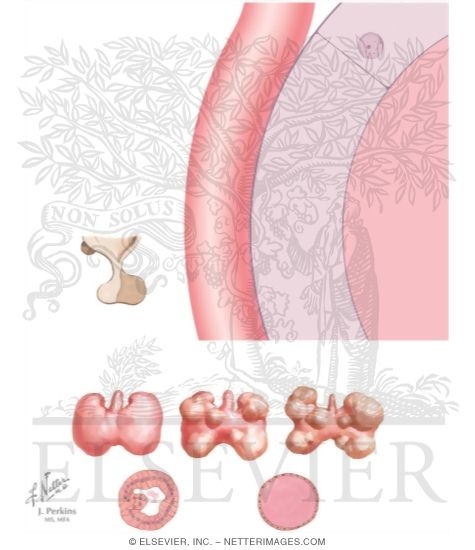Watermarked preview of unlabeled image: Etiology of Nontoxic Goiter