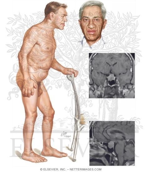 Acromegaly