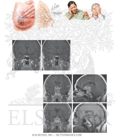 Watermarked preview of unlabeled image: Prolactin-Secreting Pituitary Tumor