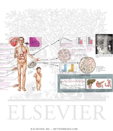 Watermarked preview of unlabeled image: Signs and Symptoms of Malabsorption