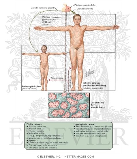 Watermarked preview of labeled image: Pituitary Anterior Lobe Deficiency in Childhood and Adolescence in Boys