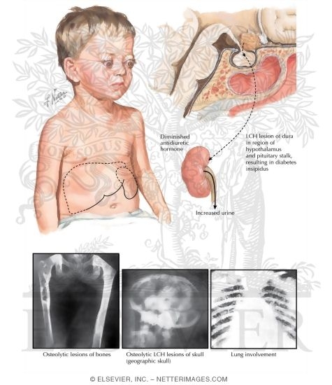 Normocholesterolemic Eosinophilic Xanthomatous Granuloma