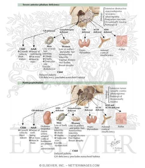 Effects of Severe Anterior Pituitary Deficiency and Panhypopituitarism