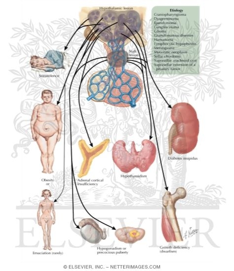 Watermarked preview of labeled image: Manifestations of Suprasellar Disease